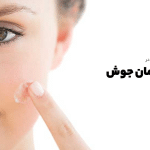 تاثیر سوربیتول در درمان جوش